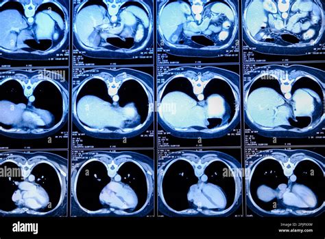 Computed Tomography (CT) Scan of the Chest .